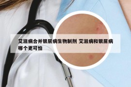 艾滋病合并银屑病生物制剂 艾滋病和银屑病哪个更可怕