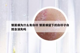 银屑病为什么有白印 银屑病留下的白印子白斑会消失吗