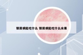 银屑病能吃什么 银屑病能吃什么水果