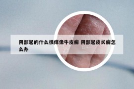 阴部起的什么很痒像牛皮癣 阴部起皮长癣怎么办