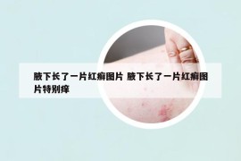 腋下长了一片红癣图片 腋下长了一片红癣图片特别痒