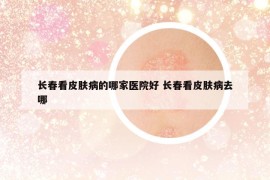 长春看皮肤病的哪家医院好 长春看皮肤病去哪