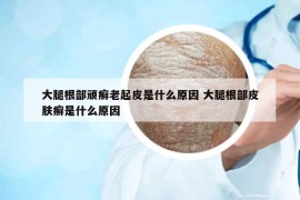 大腿根部顽癣老起皮是什么原因 大腿根部皮肤癣是什么原因