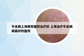 牛皮癣上海哪家医院治疗好 上海治疗牛皮病癣最好的医院