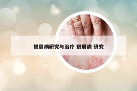 银屑病研究与治疗 银屑病 研究