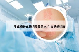 牛皮癣什么情况需要吊水 牛皮肤癣输液