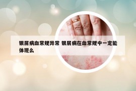 银屑病血常规异常 银屑病在血常规中一定能体现么