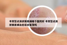 寻常型点滴状银屑病哪个医院好 寻常型点滴状银屑病治愈后会复发吗