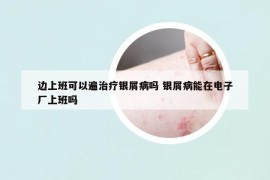 边上班可以遍治疗银屑病吗 银屑病能在电子厂上班吗