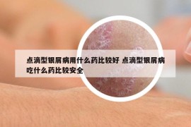 点滴型银屑病用什么药比较好 点滴型银屑病吃什么药比较安全