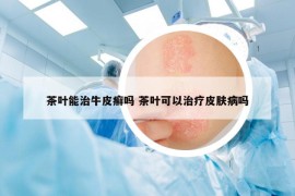 茶叶能治牛皮癣吗 茶叶可以治疗皮肤病吗