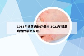 2023年银屑病诊疗指南 2021年银屑病治疗最新突破