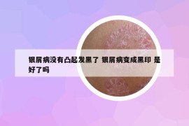 银屑病没有凸起发黑了 银屑病变成黑印 是好了吗