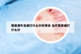 银屑病牛皮癣打什么针好得快 治疗银屑病打什么针