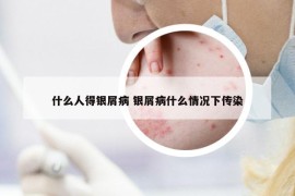 什么人得银屑病 银屑病什么情况下传染