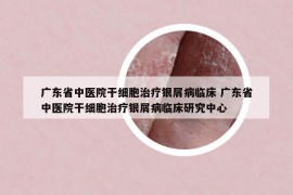 广东省中医院干细胞治疗银屑病临床 广东省中医院干细胞治疗银屑病临床研究中心