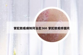 掌跎脓疱病如何治愈360 掌跎脓疱疹图片