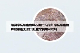 请问掌跖脓疱病脚心用什么药膏 掌跖脓疱病脚底脓疱无法行走,把它挑破可以吗