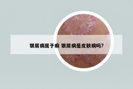 银屑病属于癣 银屑病是皮肤病吗?