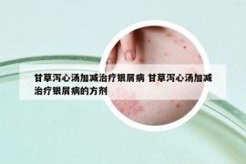 甘草泻心汤加减治疗银屑病 甘草泻心汤加减治疗银屑病的方剂