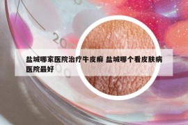 盐城哪家医院治疗牛皮癣 盐城哪个看皮肤病医院最好