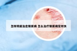 怎样彻底治愈银屑病 怎么治疗银屑病见效快