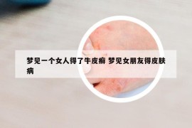 梦见一个女人得了牛皮癣 梦见女朋友得皮肤病