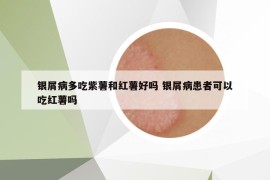 银屑病多吃紫薯和红薯好吗 银屑病患者可以吃红薯吗