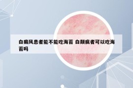 白癜风患者能不能吃海苔 白颠疯者可以吃海苔吗