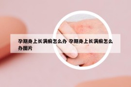 孕期身上长满癣怎么办 孕期身上长满癣怎么办图片