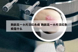 胸前出一小片淡红色癣 胸前出一小片淡红色癣是什么