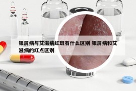 银屑病与艾滋病红斑有什么区别 银屑病和艾滋病的红点区别