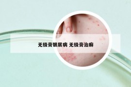 无极膏银屑病 无极膏治癣