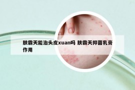 肤霸天能治头皮xuan吗 肤霸天抑菌乳膏作用