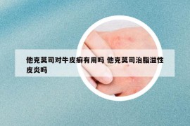 他克莫司对牛皮癣有用吗 他克莫司治脂溢性皮炎吗