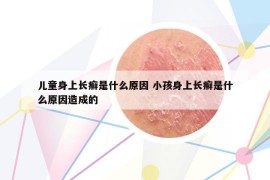 儿童身上长癣是什么原因 小孩身上长癣是什么原因造成的