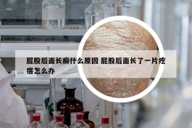 屁股后面长癣什么原因 屁股后面长了一片疙瘩怎么办