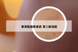 掌泽脓疱疹症状 掌晢脓泡症