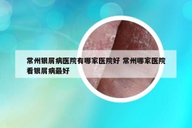 常州银屑病医院有哪家医院好 常州哪家医院看银屑病最好