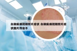 白颠疯病初期照片症状 白颠疯病初期照片症状图片传染不