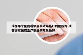 成都那个医院看银屑病效果最好的医院好 成都哪家医院治疗银屑病效果最好