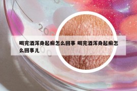 喝完酒浑身起癣怎么回事 喝完酒浑身起癣怎么回事儿