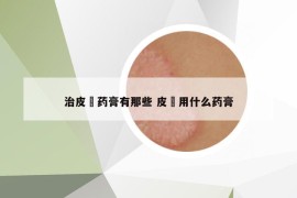 治皮廯药膏有那些 皮廯用什么药膏