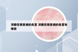 浓胞性银屑病的危害 浓胞性银屑病的危害有哪些