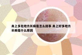 身上多处地方长癣是怎么回事 身上好多地方长癣是什么原因