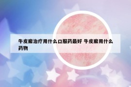 牛皮廨治疗用什么口服药最好 牛皮廨用什么药物