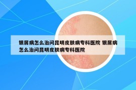 银屑病怎么治问昆明皮肤病专科医院 银屑病怎么治问昆明皮肤病专科医院