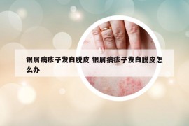 银屑病疹子发白脱皮 银屑病疹子发白脱皮怎么办