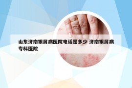 山东济南银屑病医院电话是多少 济南银屑病专科医院