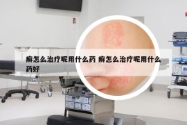 癣怎么治疗呢用什么药 癣怎么治疗呢用什么药好